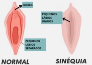 Sinéquia vaginal